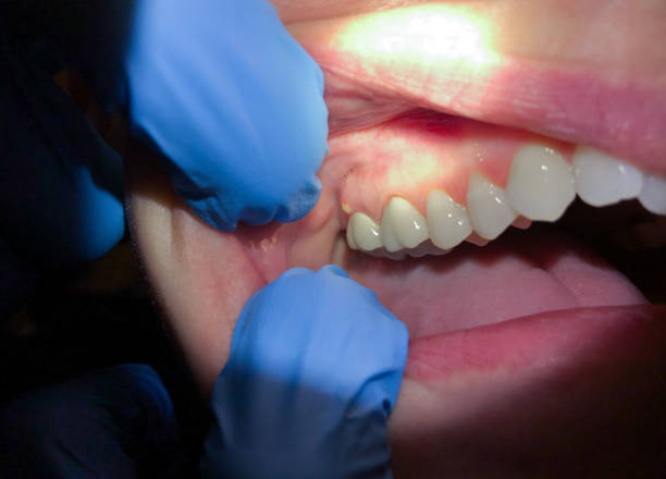 Best Knocked-Out Tooth (Avulsed Tooth) Treatment in Rural Hall, NC